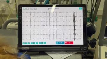 ECG